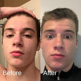 Shield Men's Acne Body Wash for Back, Chest & Shoulders - 4% Benzoyl Peroxide Body Wash, Clears Breakouts & Acne Scars – Unscented with Niacinamide, Glycolic Acid & Ceramides, 8.5 oz