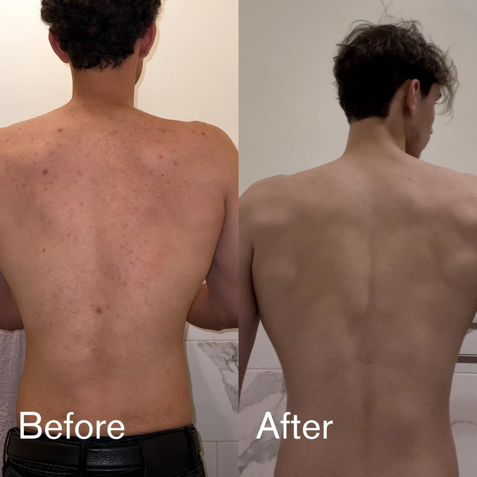 Shield Men's Acne Body Wash for Back, Chest & Shoulders - 4% Benzoyl Peroxide Body Wash, Clears Breakouts & Acne Scars – Unscented with Niacinamide, Glycolic Acid & Ceramides, 8.5 oz