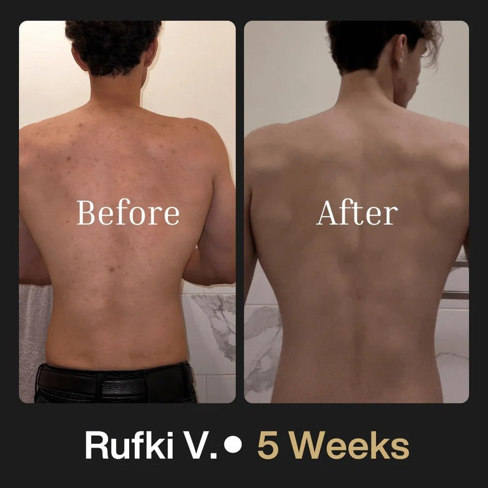 Shield Men's Acne Body Wash for Back, Chest & Shoulders - 4% Benzoyl Peroxide Body Wash, Clears Breakouts & Acne Scars – Unscented with Niacinamide, Glycolic Acid & Ceramides, 8.5 oz