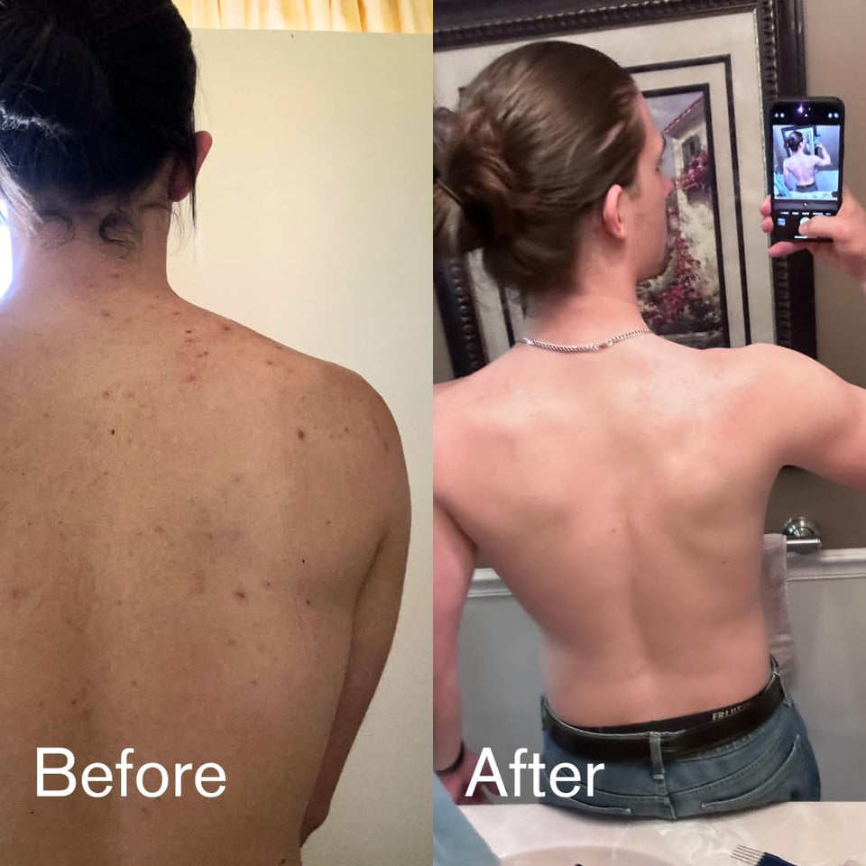 Shield Men's Acne Body Wash for Back, Chest & Shoulders - 4% Benzoyl Peroxide Body Wash, Clears Breakouts & Acne Scars – Unscented with Niacinamide, Glycolic Acid & Ceramides, 8.5 oz