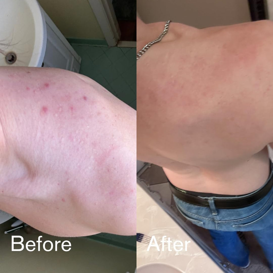 Shield Men's Acne Body Wash for Back, Chest & Shoulders - 4% Benzoyl Peroxide Body Wash, Clears Breakouts & Acne Scars – Unscented with Niacinamide, Glycolic Acid & Ceramides, 8.5 oz